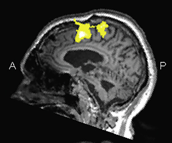 Neural responses to speech can help to diagnose brain injury