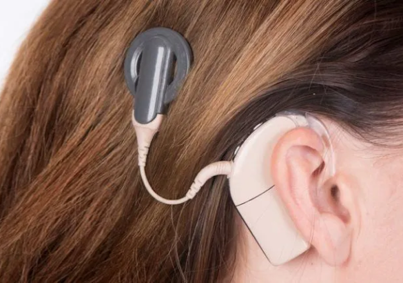 Attention decoding in users of hearing aids and cochlear implants